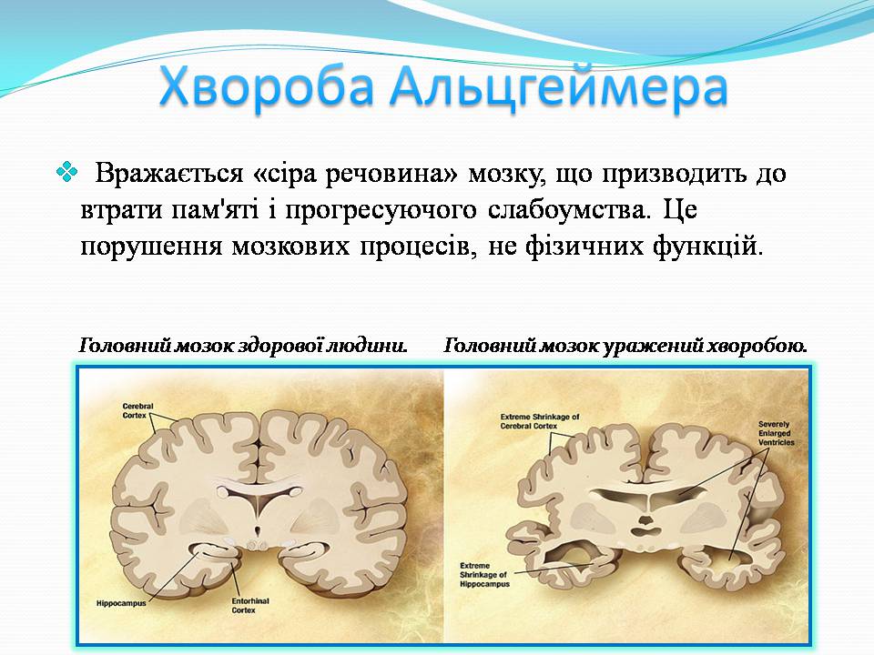 Презентація на тему «Генетичні захворювання» (варіант 2) - Слайд #12