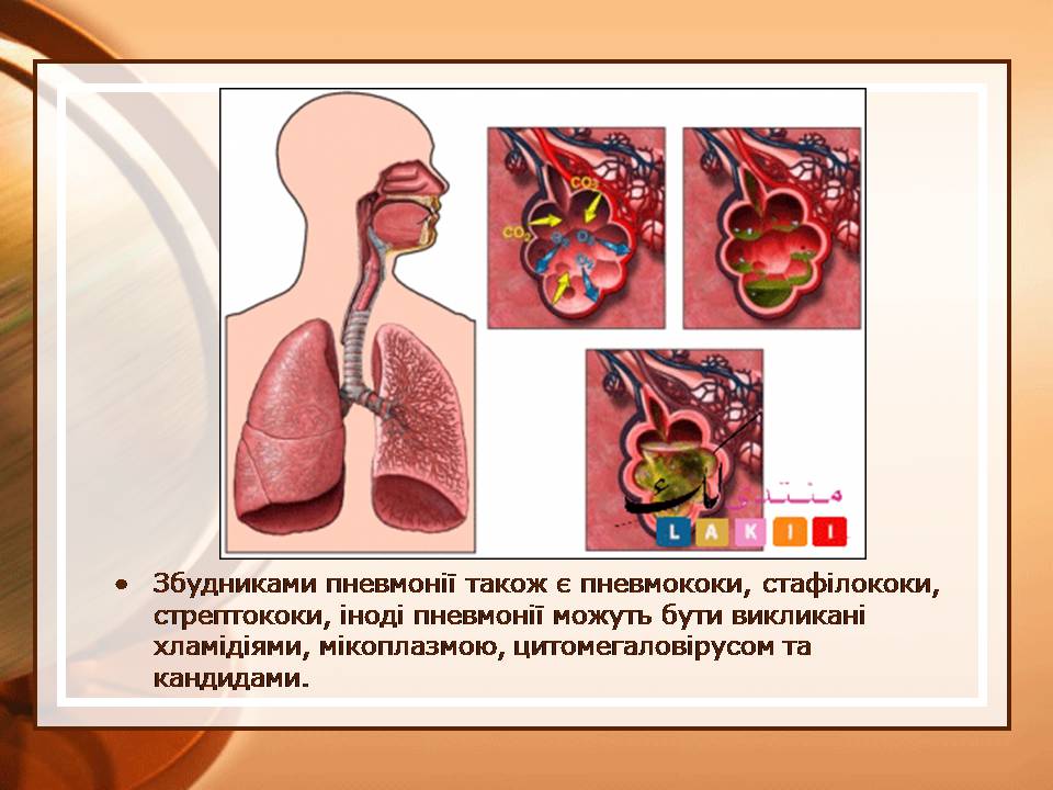 Презентація на тему «Пневмонія» - Слайд #5