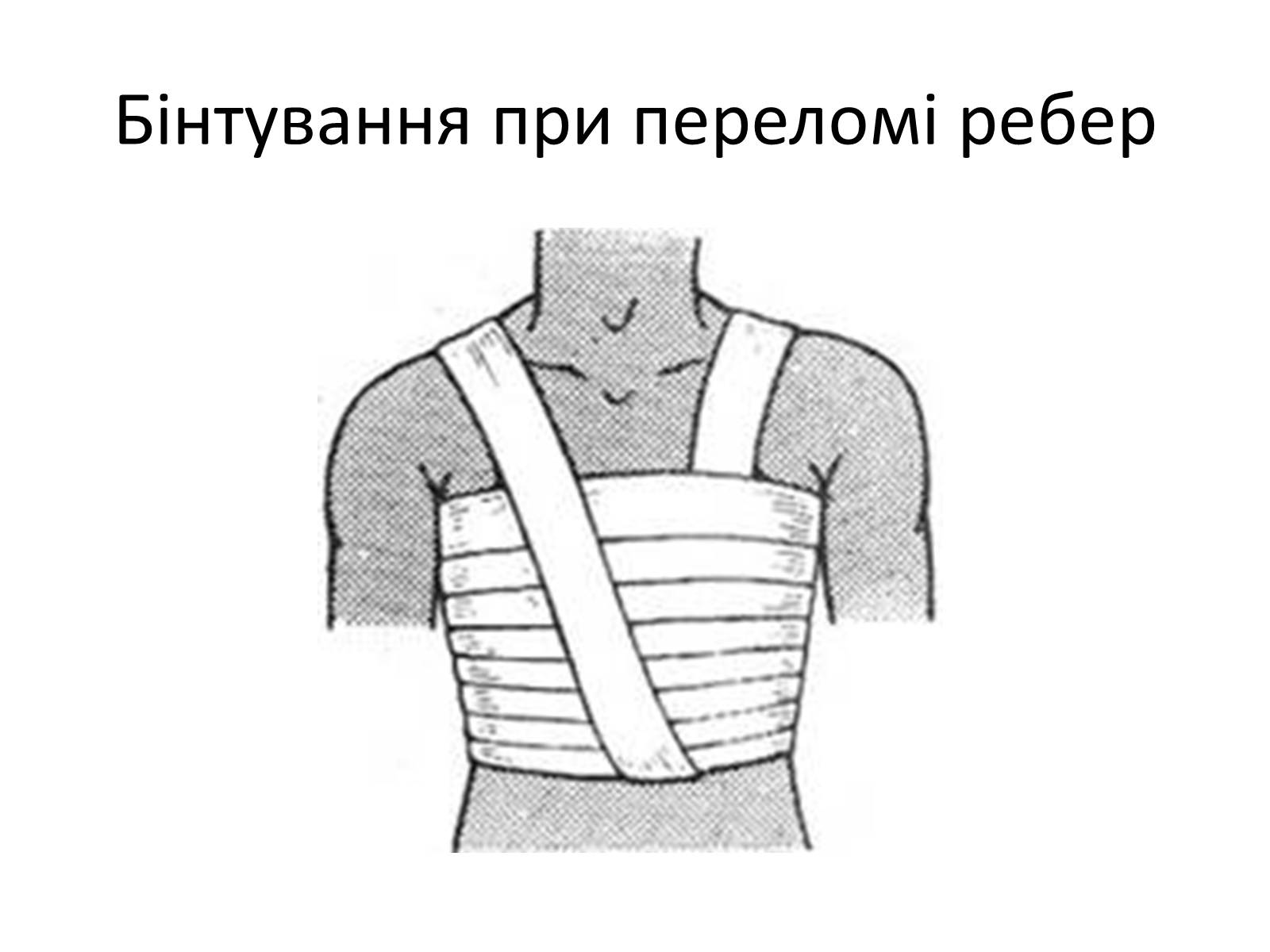 Презентація на тему «Переломи та вивихи. Перша допомога» - Слайд #22