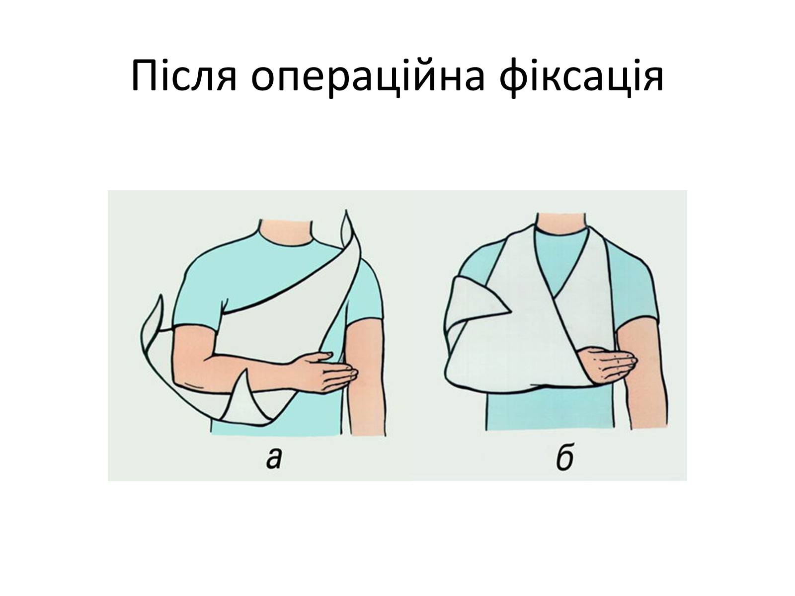 Презентація на тему «Переломи та вивихи. Перша допомога» - Слайд #9