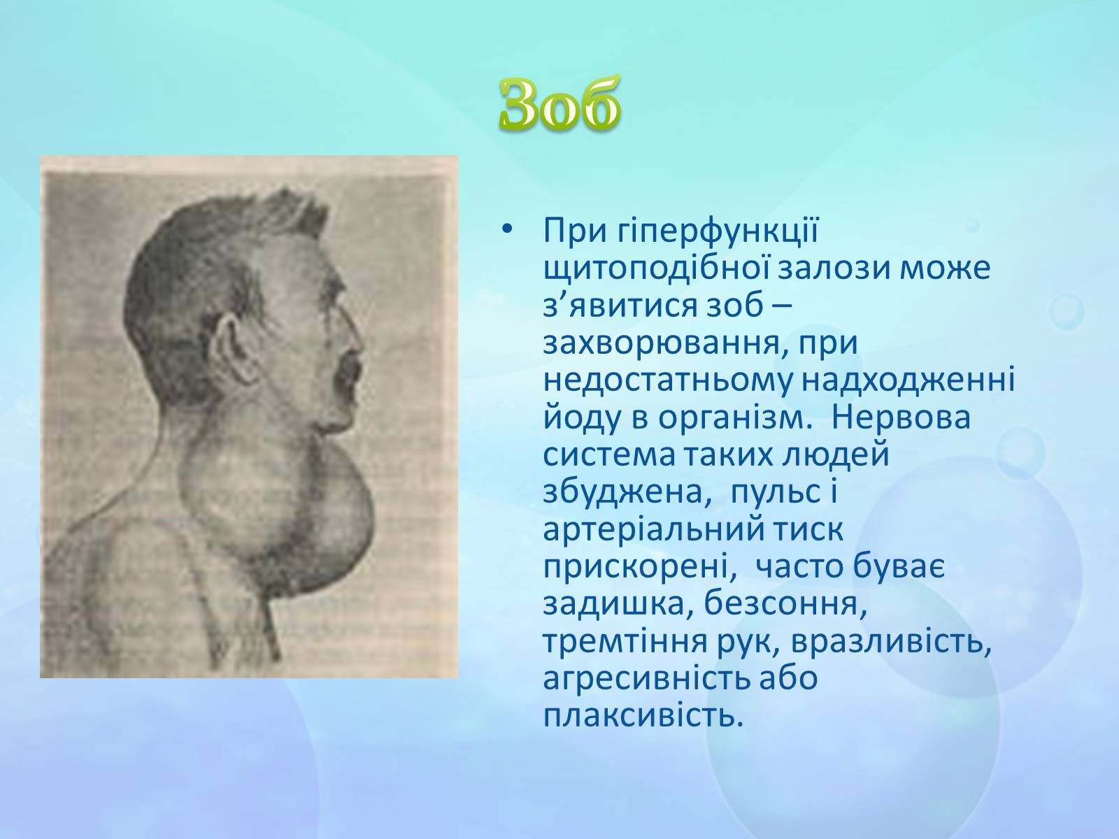 Презентація на тему «Щитоподібна залоза» - Слайд #8