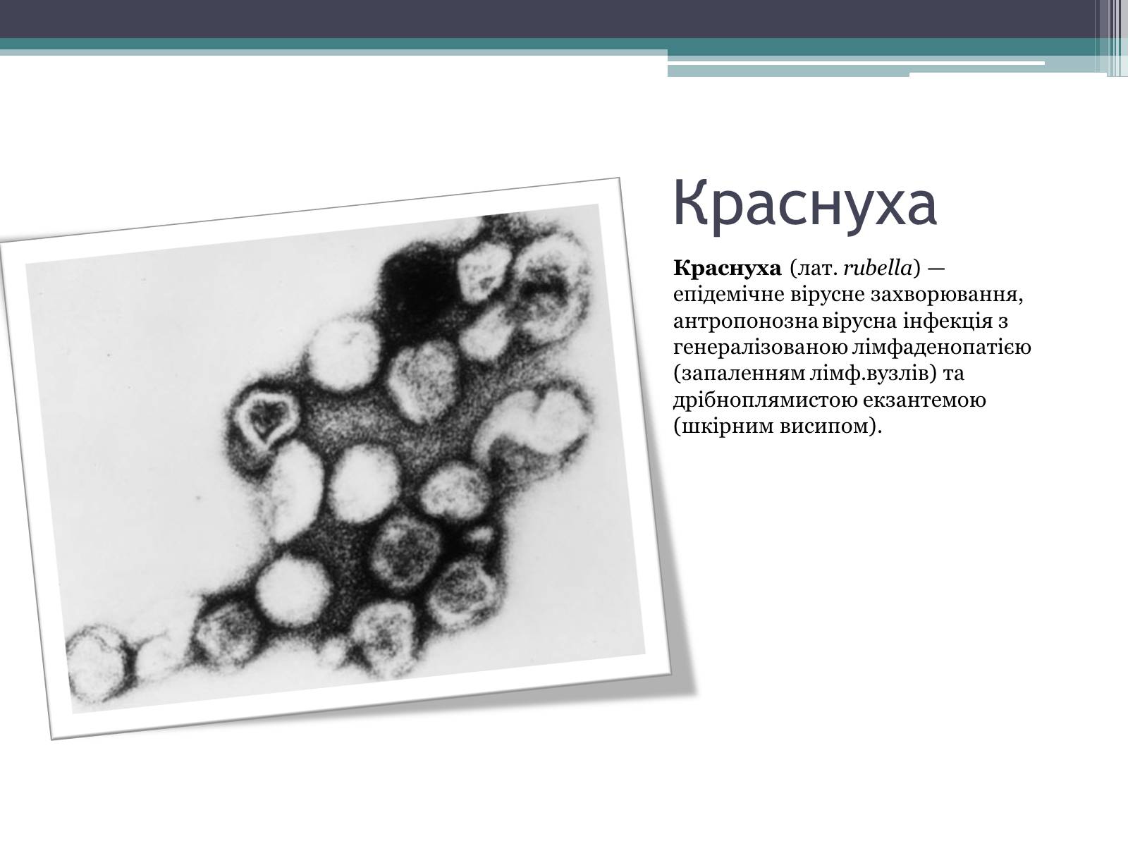 Презентація на тему «Дитячі інфекційні захворювання» - Слайд #13