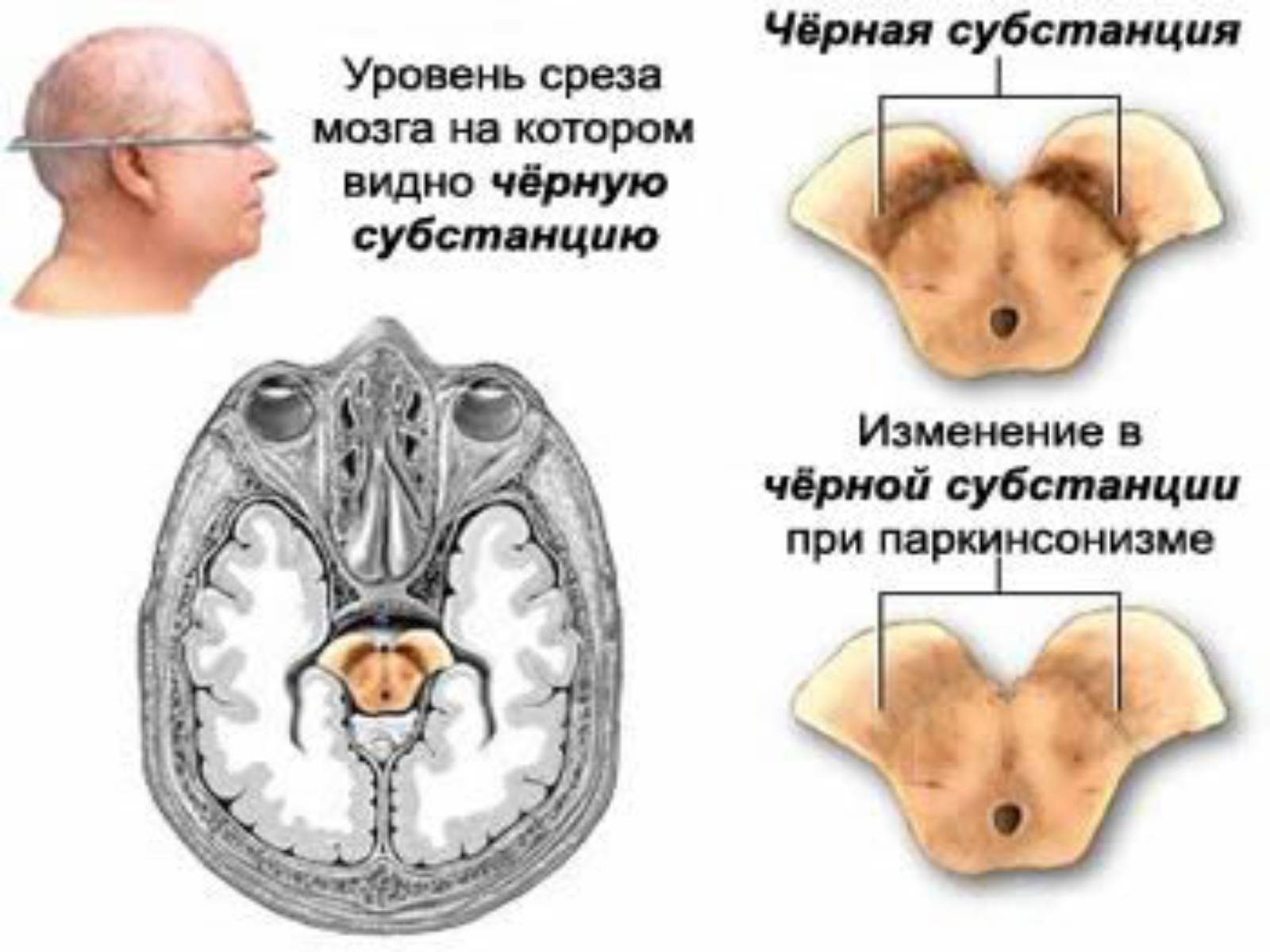 Презентація на тему «Хвороби нервової системи» (варіант 1) - Слайд #7