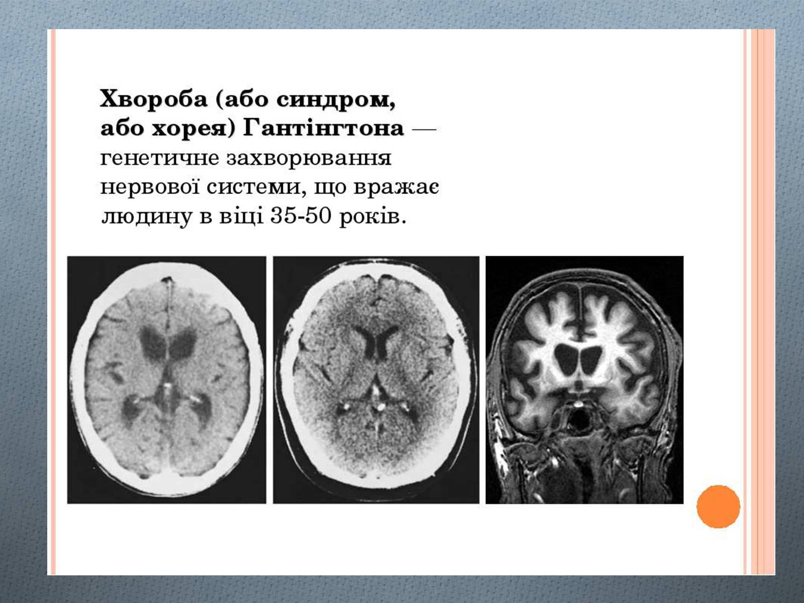 Презентація на тему «Генетичні хвороби» - Слайд #7