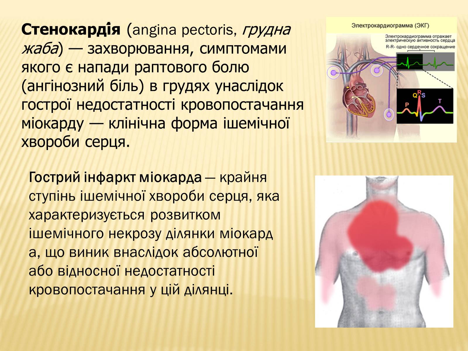 Презентація на тему «Захворювання серцево-судинної системи» (варіант 3) - Слайд #8