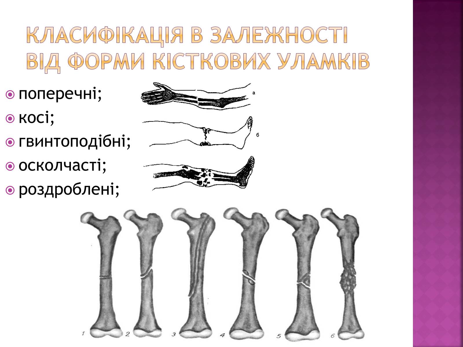 Презентація на тему «Переломи і вивихи» (варіант 4) - Слайд #4