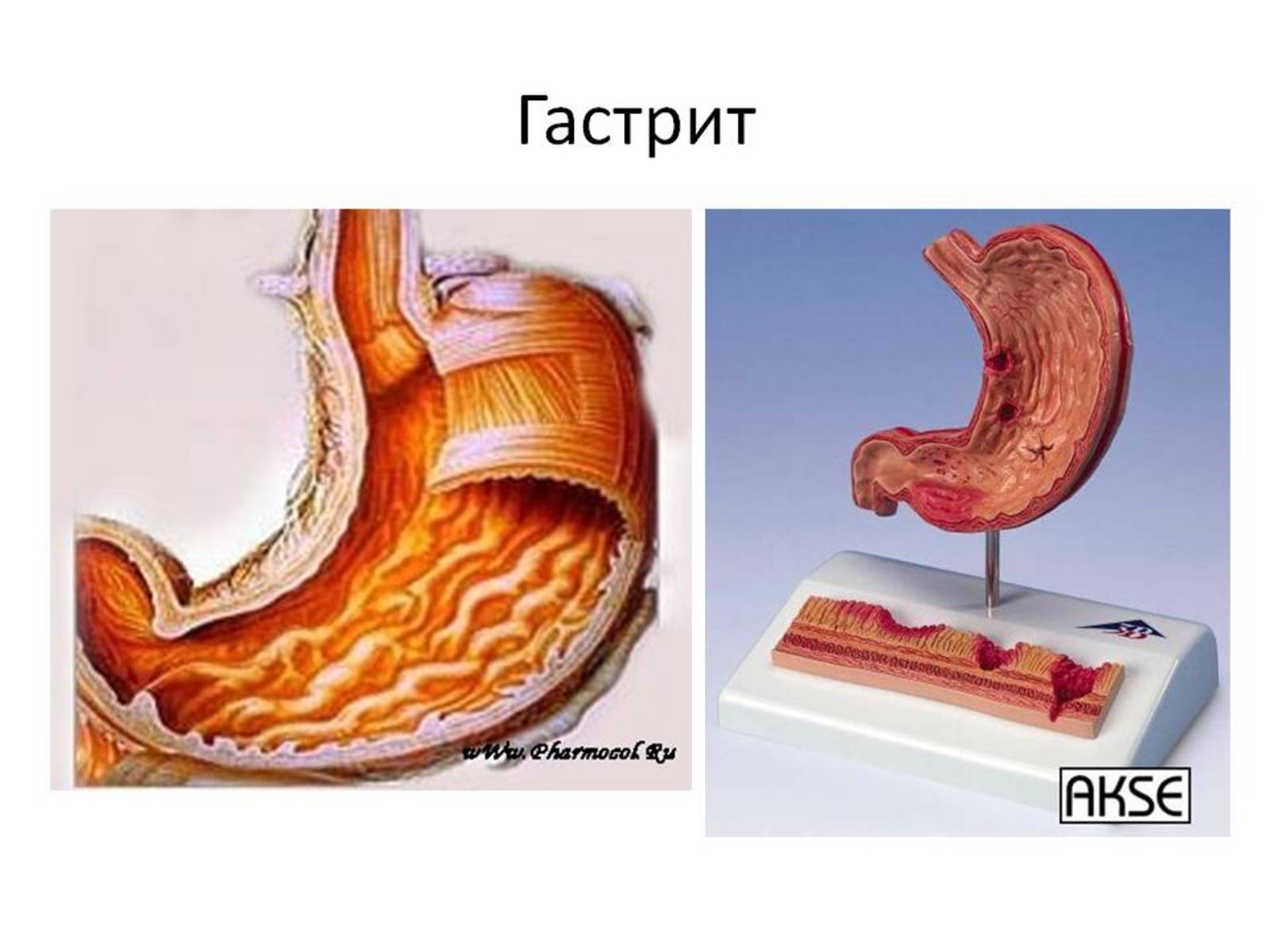 Презентація на тему «Гастрит» - Слайд #3