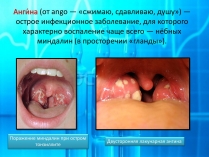 Презентація на тему «Ангина»