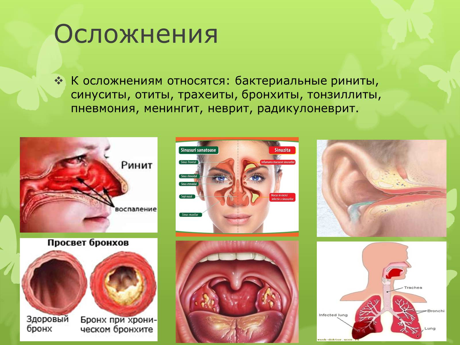 Презентація на тему «Острая респираторная вирусная инфекция» - Слайд #5