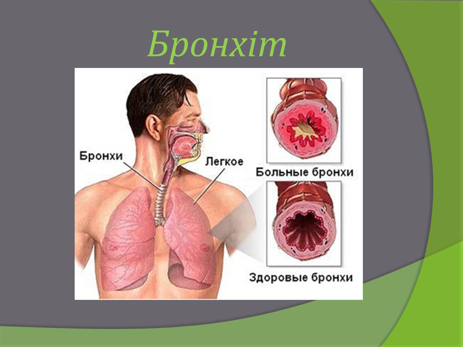 Презентація на тему «Бронхіт» - Слайд #1