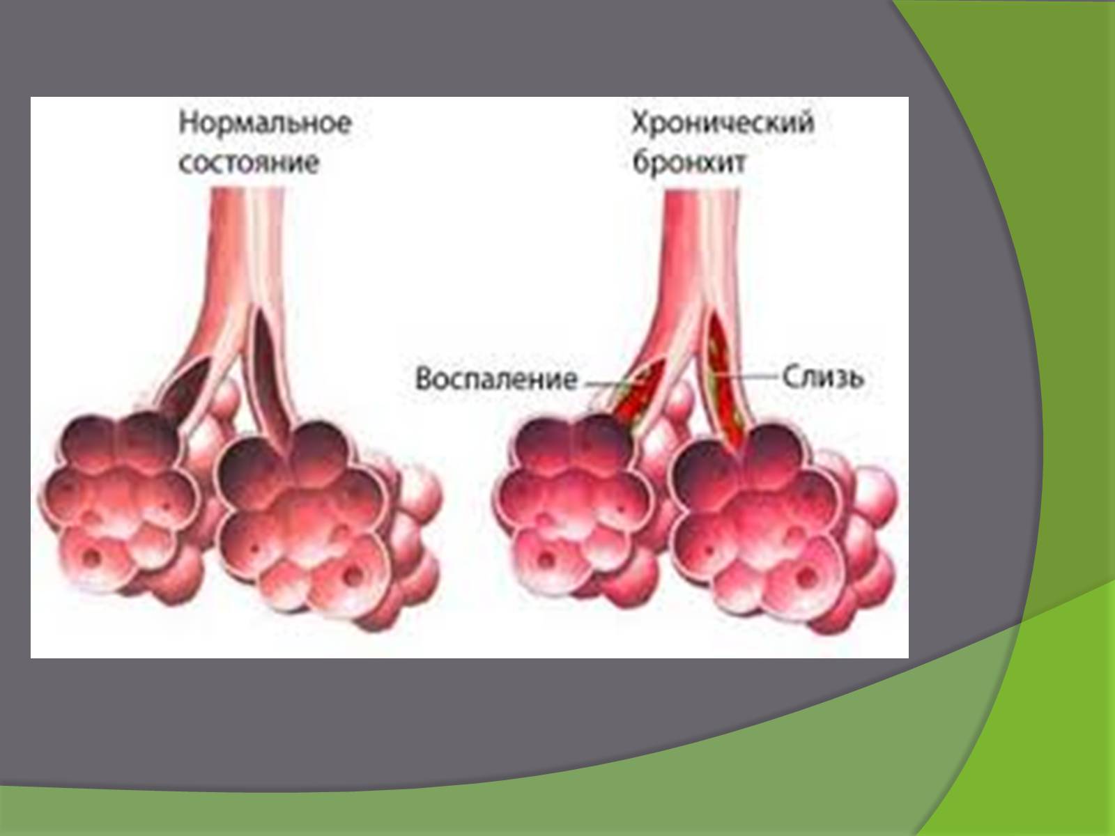 Презентація на тему «Бронхіт» - Слайд #9