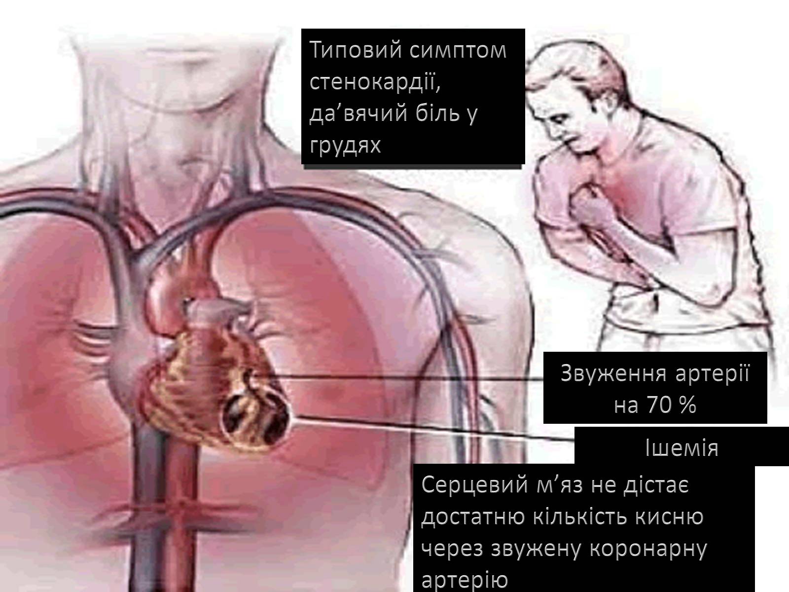 Презентація на тему «Методи відновлення кровообігу в уражених атеросклерозом коронарних артеріях при ішемічній хворобі серця» - Слайд #11