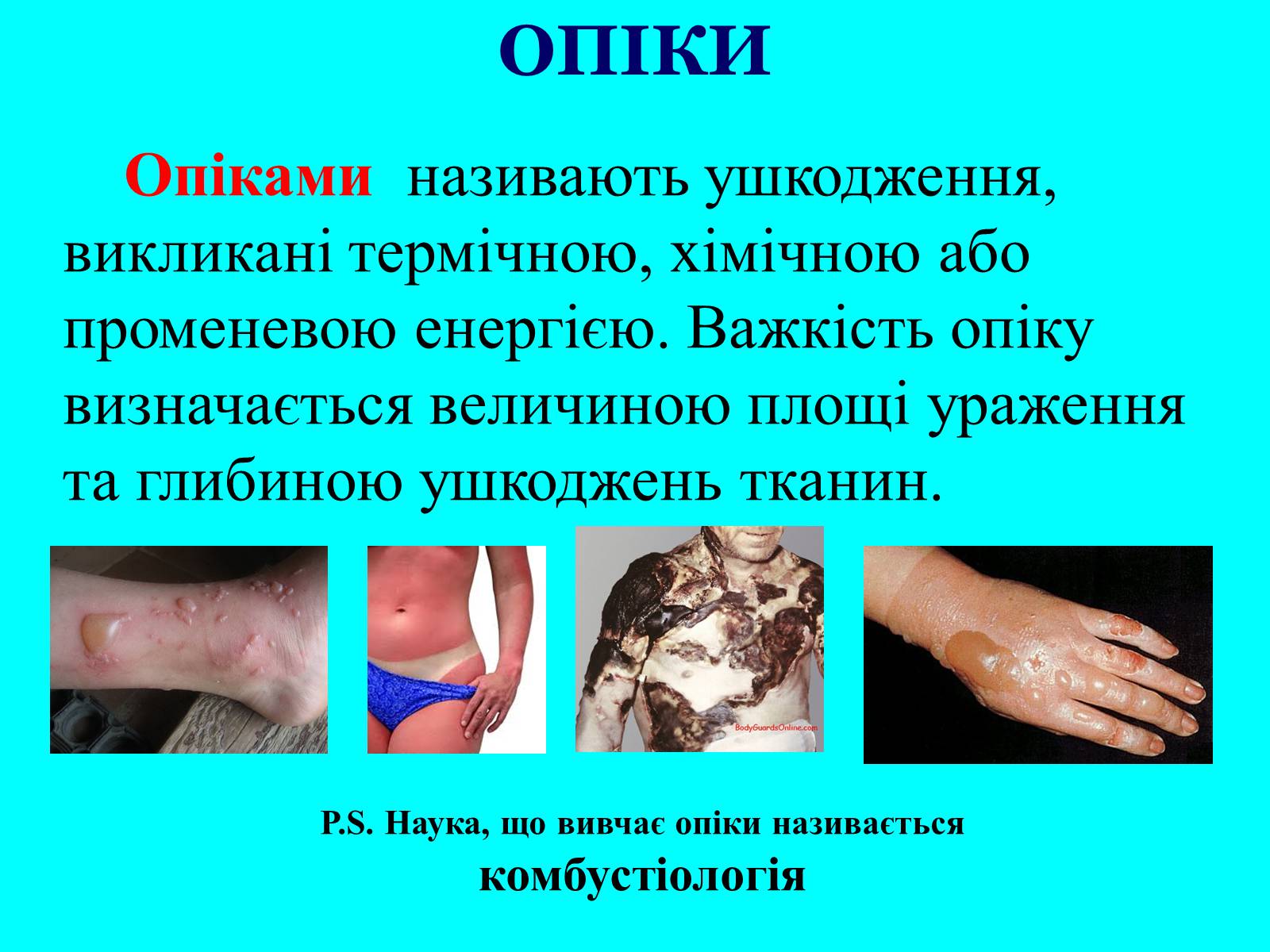 Презентація на тему «Опіки: види, причини, надання першої допомоги» - Слайд #3