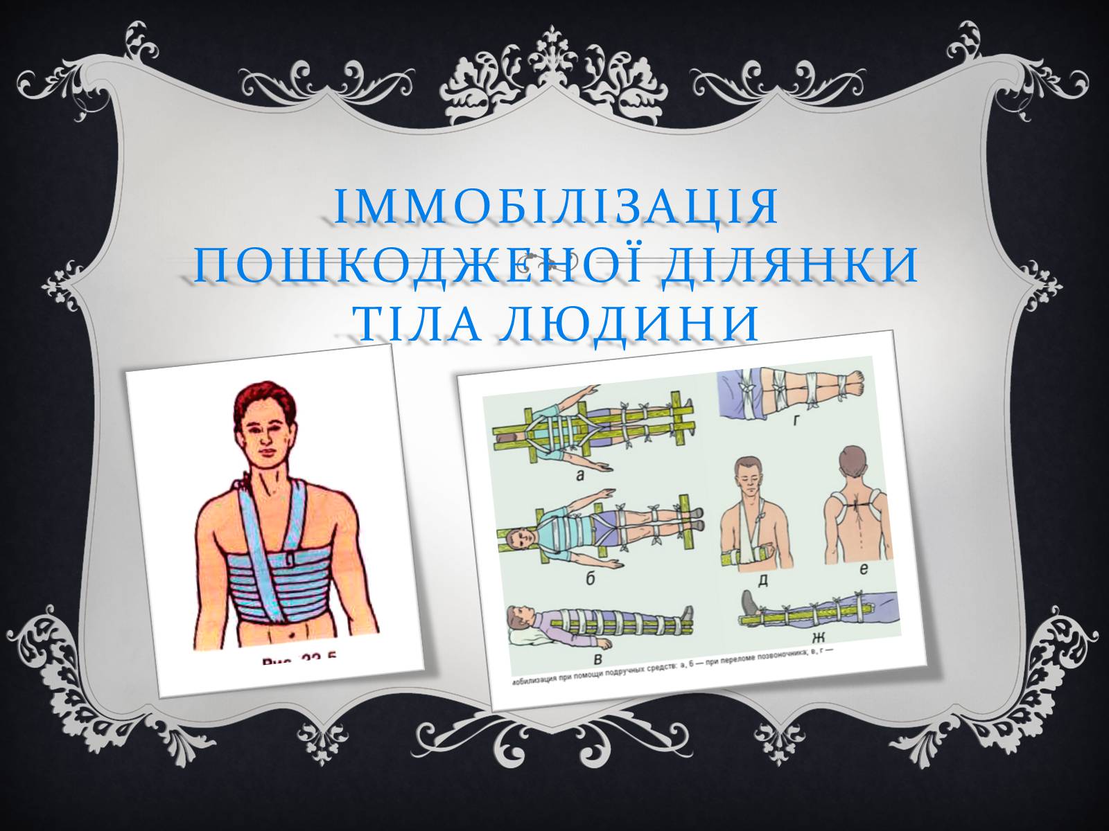 Презентація на тему «Іммобілізація пошкодженої ділянки тіла людини» - Слайд #1