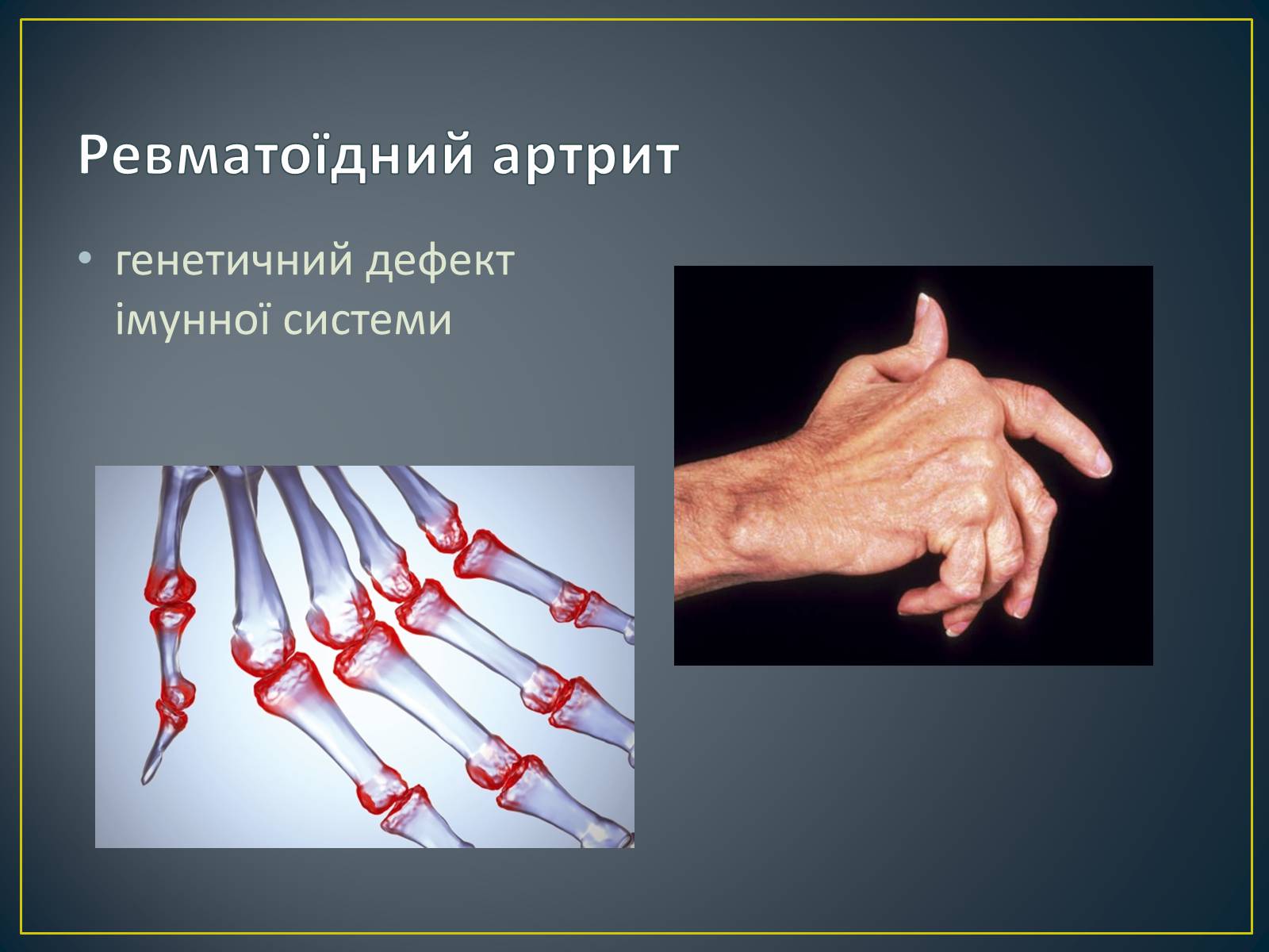 Презентація на тему «Типи генетичних хвороб людини» (варіант 2) - Слайд #13