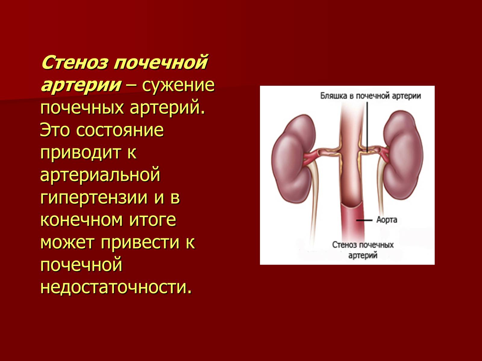 Презентація на тему «Вазоренальная гипертензия» - Слайд #3