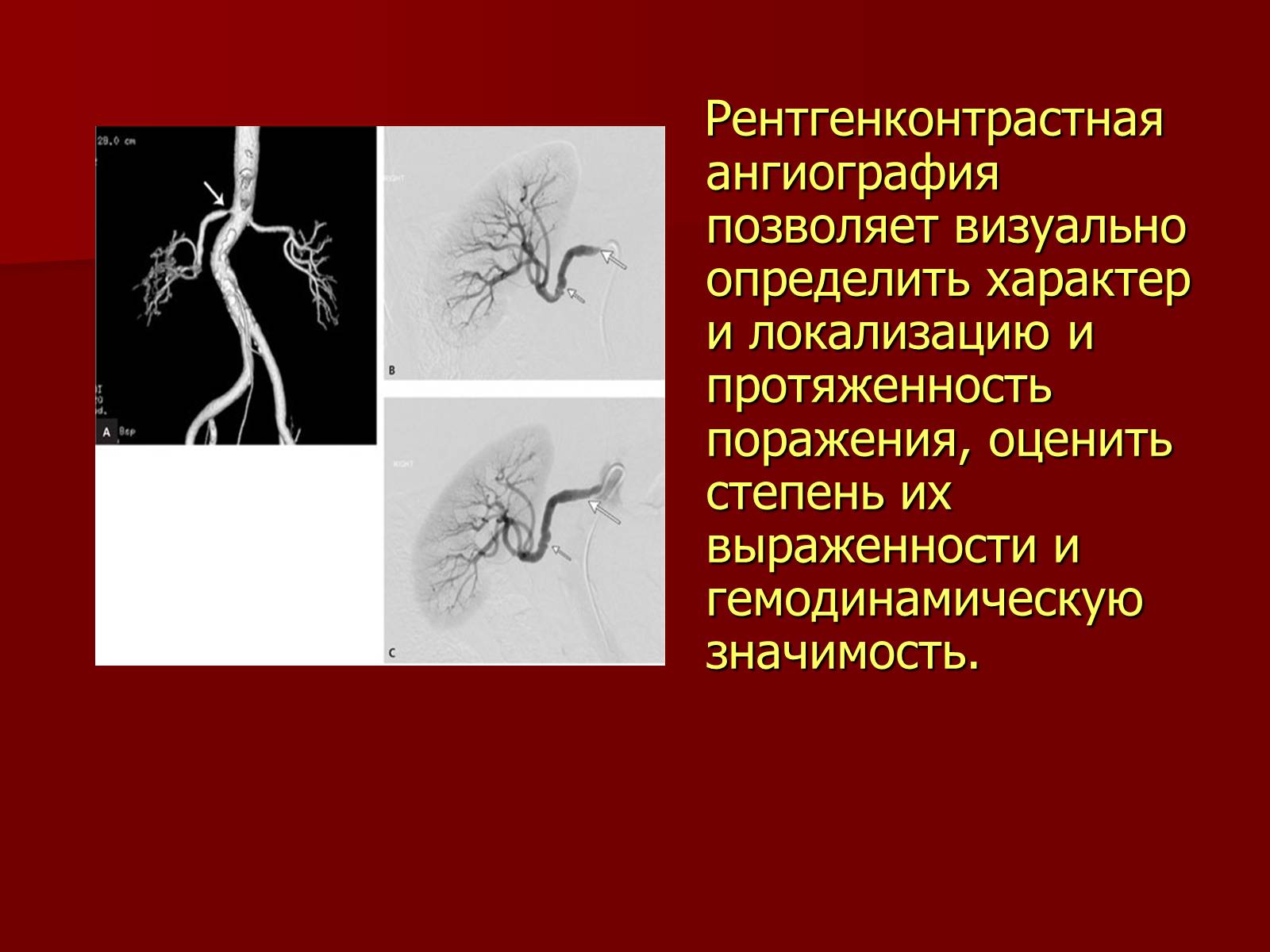 Презентація на тему «Вазоренальная гипертензия» - Слайд #9