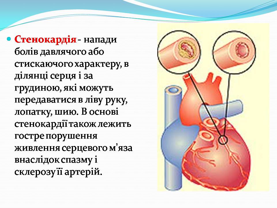 Презентація на тему «Найчастіші захвонювання людей» - Слайд #14