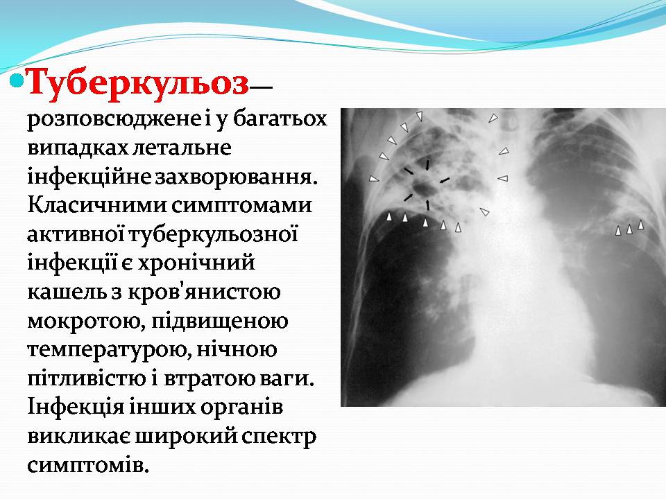 Презентація на тему «Найчастіші захвонювання людей» - Слайд #22