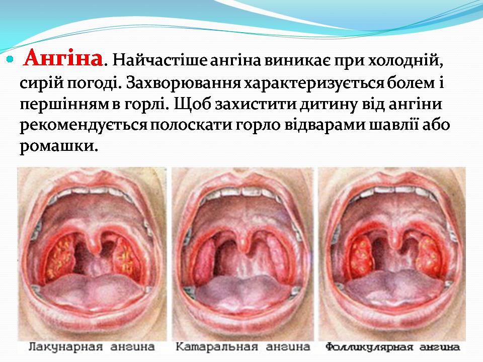 Презентація на тему «Найчастіші захвонювання людей» - Слайд #9