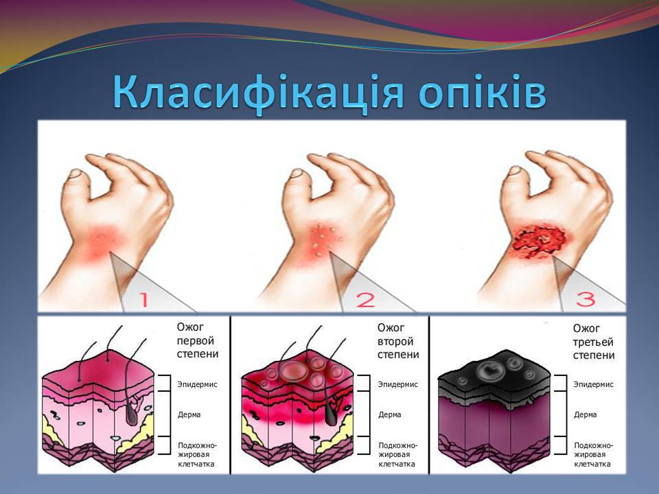 Презентація на тему «Опіки. Перша допомога при опіках» - Слайд #7